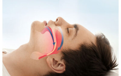 How Does Sleep Apnea Cause Cardiovascular Disease?